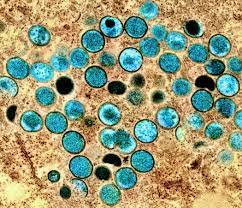 Monkeypox: Are We Any Closer to a Cure?
